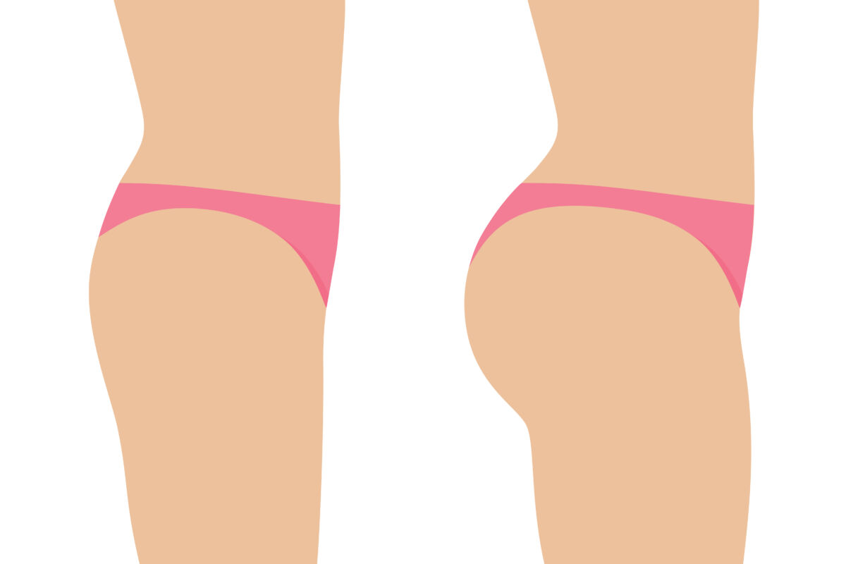 Brazilian Butt Lift Surgery - Ocala Plastic Surgery